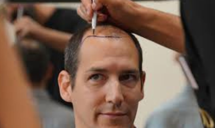 Non-Surgical Hair Replacement: Restore Confidence Without Surgery